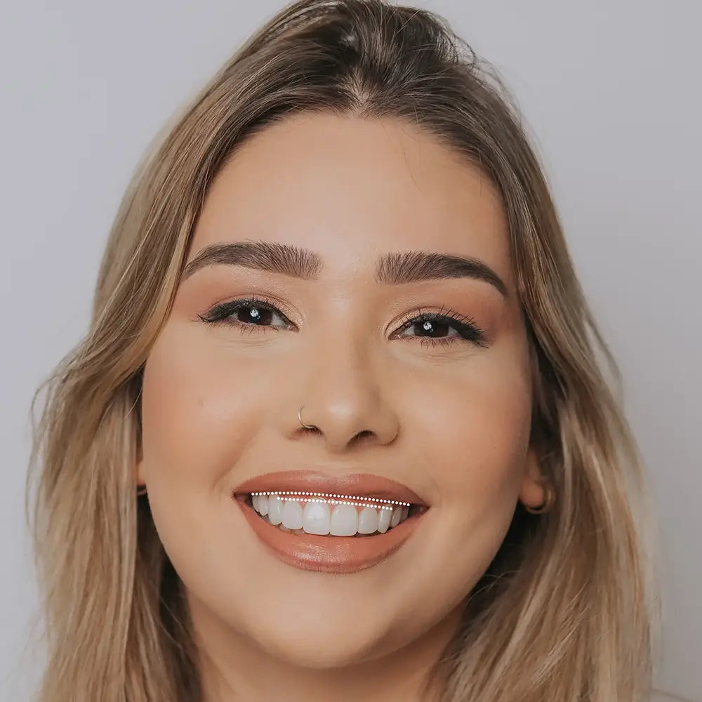 Gummy smile