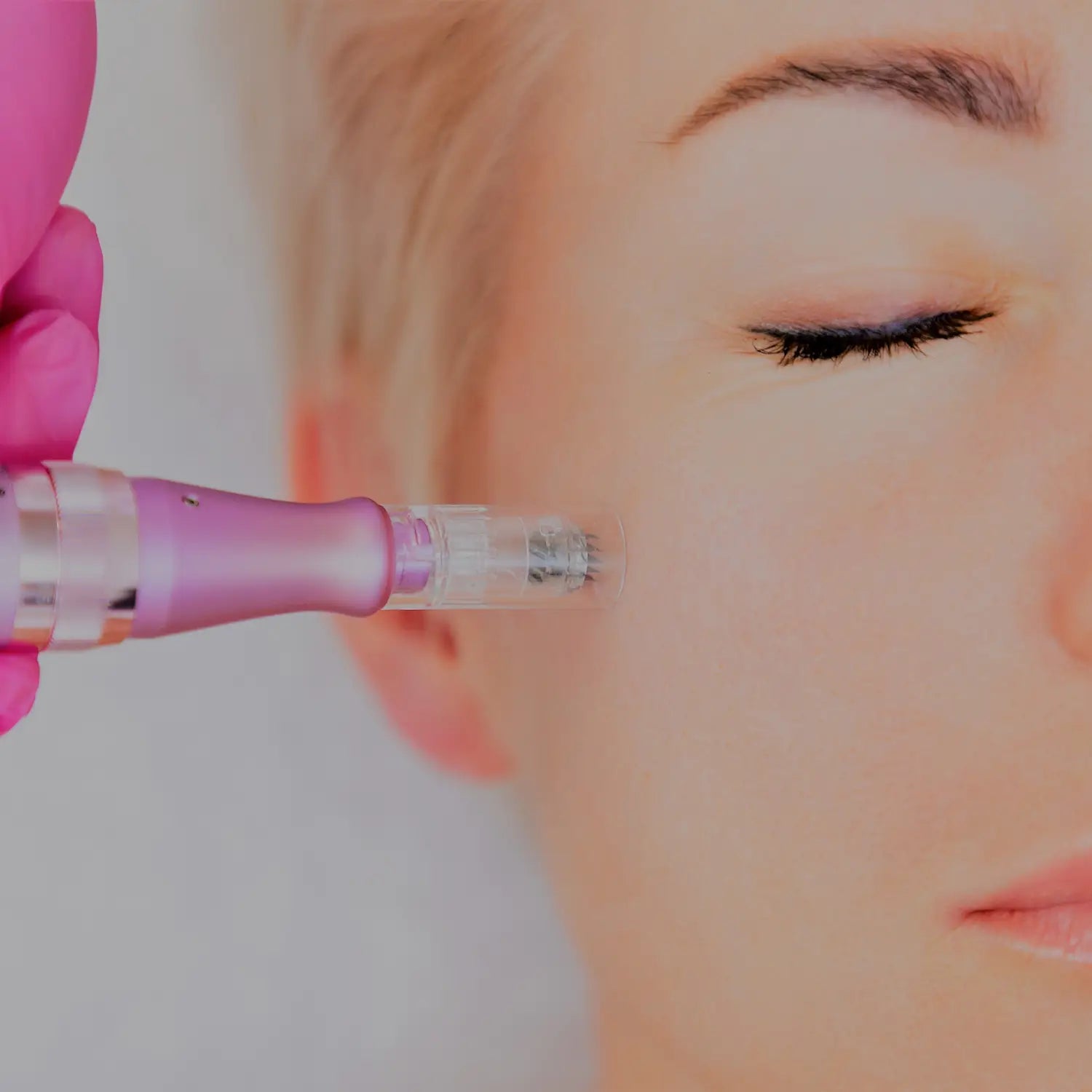 Skin needling